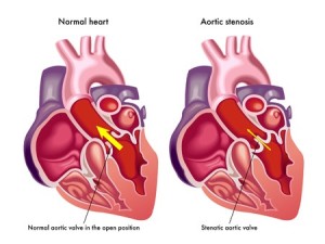 44195495 - aortic stenosis